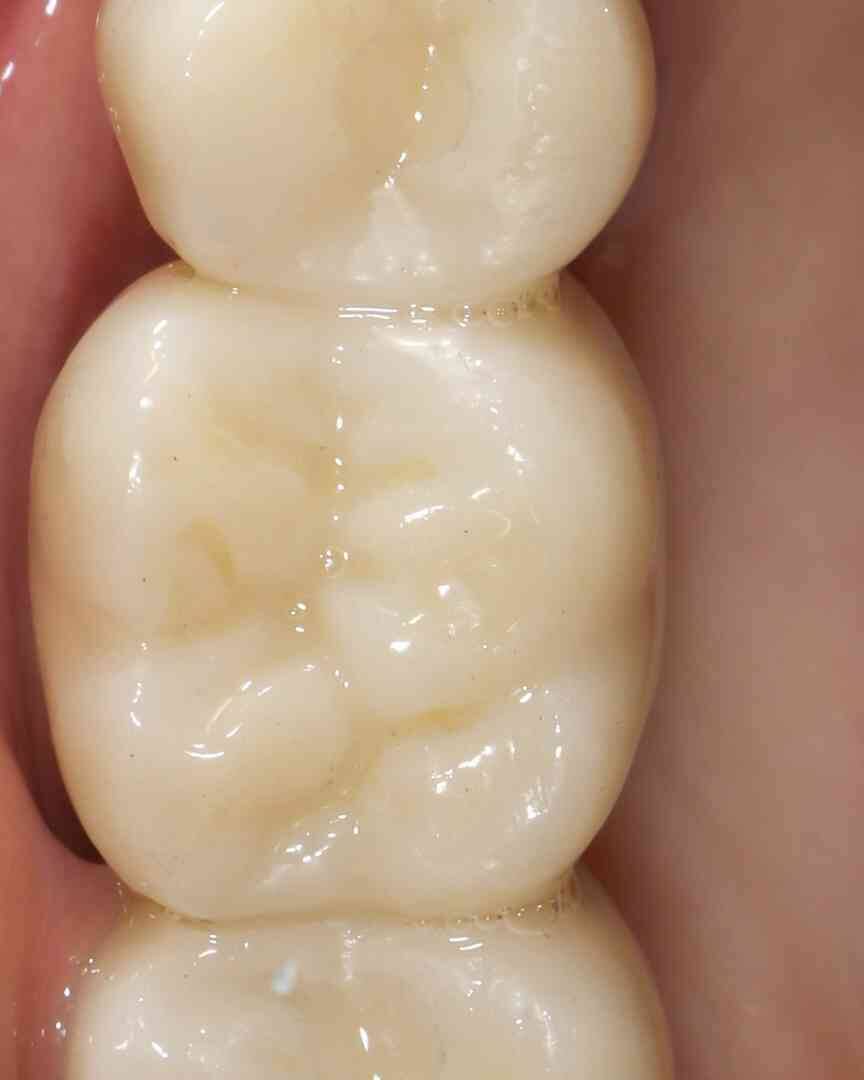 Brace and protect teeth