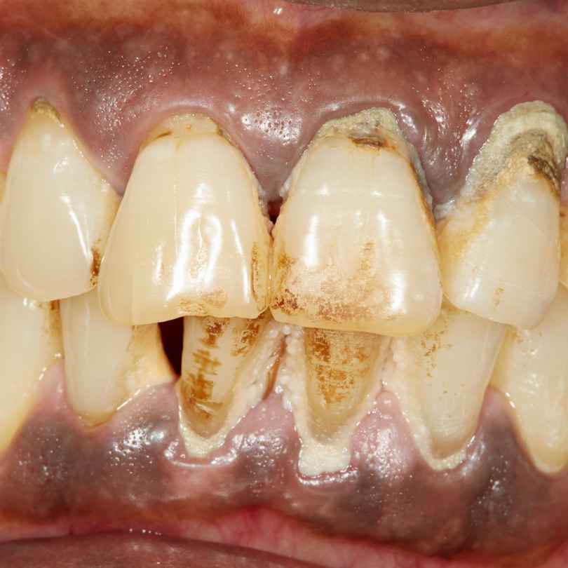 Dental Plaque and Tartar