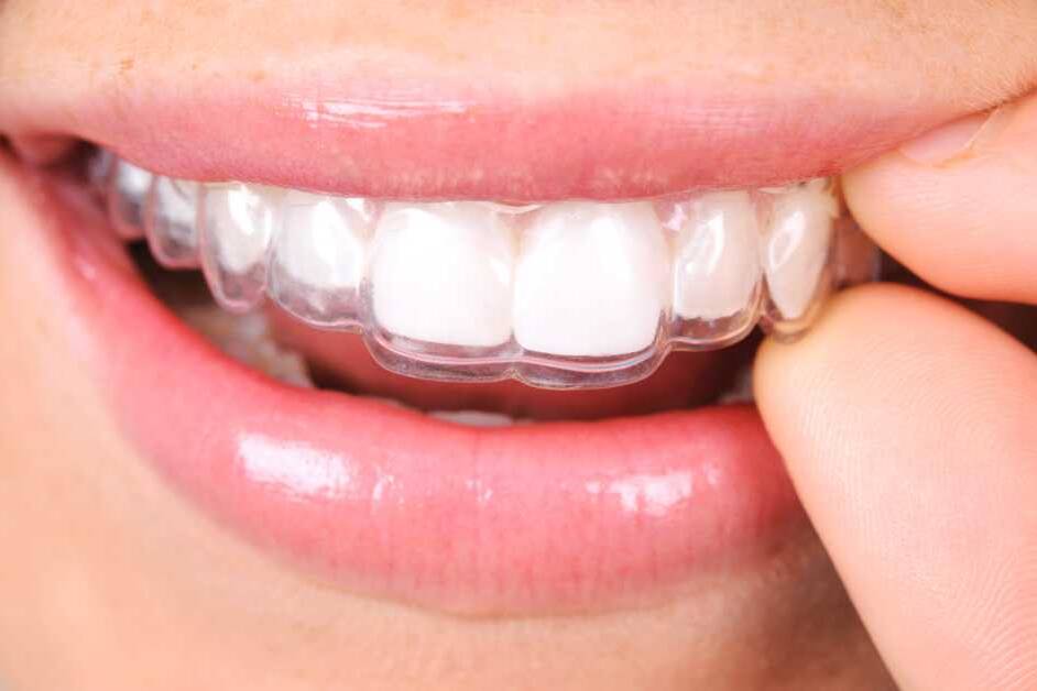 Dental Retainers