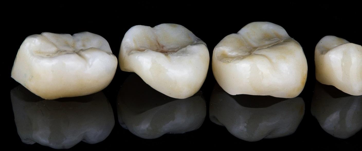 Dental Crowns Treatment at Delatite Dental Mansfield, Victoria – Restoring and Protecting Teeth