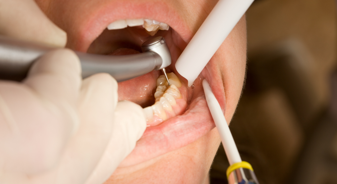 Temporary Tooth Filling Procedure at Delatite Dental – Protecting and Restoring Teeth Before Permanent Treatment
