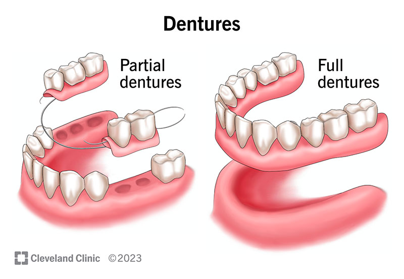 Dental Implants and Dentures