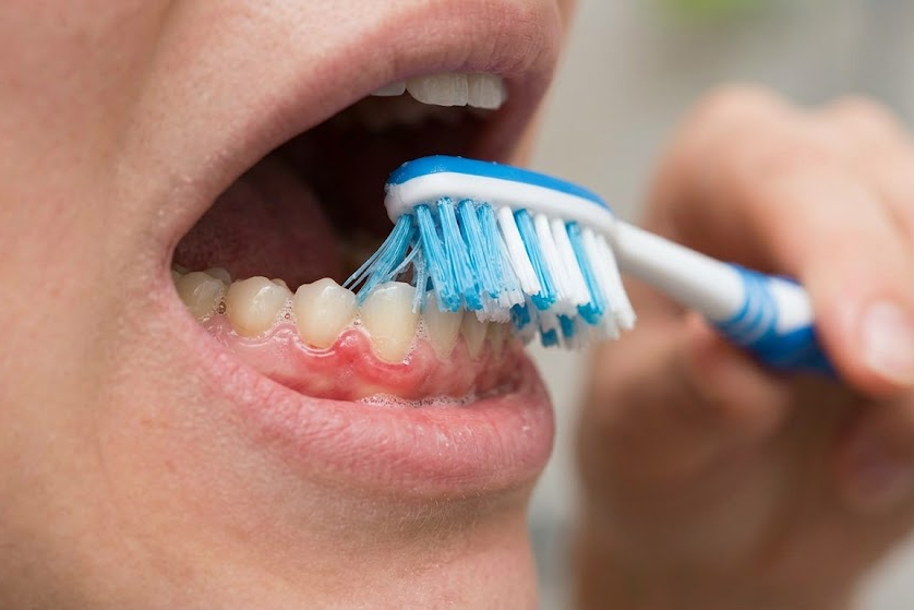 Gum Disease Symptoms